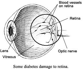Picture of eye showing some diabetes damage.