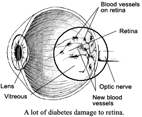 Picture of eye showing a lot of diabetes damage.