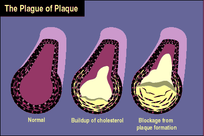 illustration of cholesterol buildup