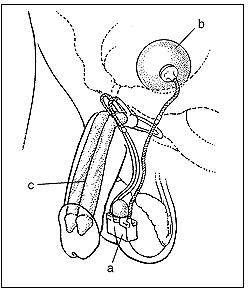 igure 3: Illustration showing inflatable implant