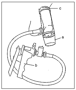 Figure 2: Illustration of a vacuum-constrictor device