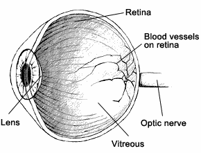 Image of eye showing lens, retina, blood vessels on retina, optic nerve, and vitreous.