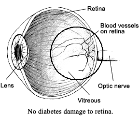 Picture of eye showing no diabetes damage.